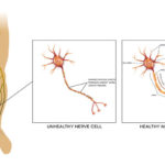 Dealing with Neuropathy